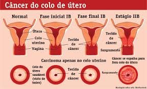 cancer-do-colo-do-utero