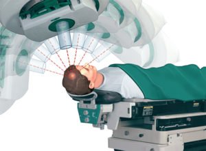 radioterapia