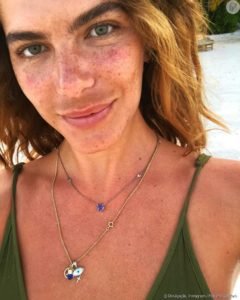 melasma-mariana-goldfarb